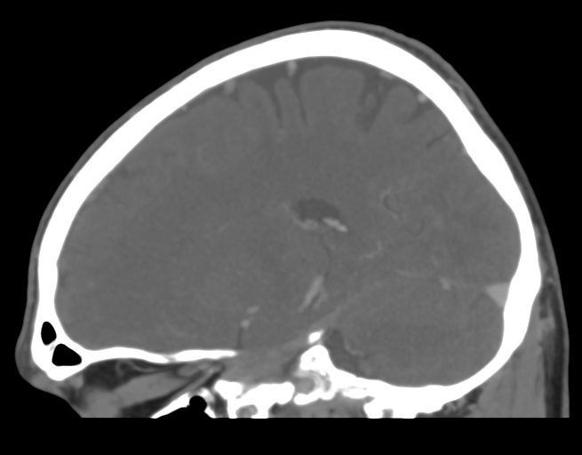 File:Cerebral venous thrombosis (Radiopaedia 38392-40467 D 20).png