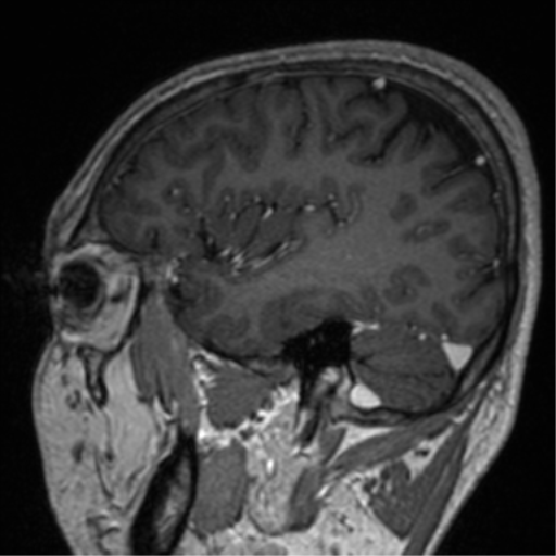 Cerebral venous thrombosis (Radiopaedia 38392-40469 Sagittal T1 C+ 25).png