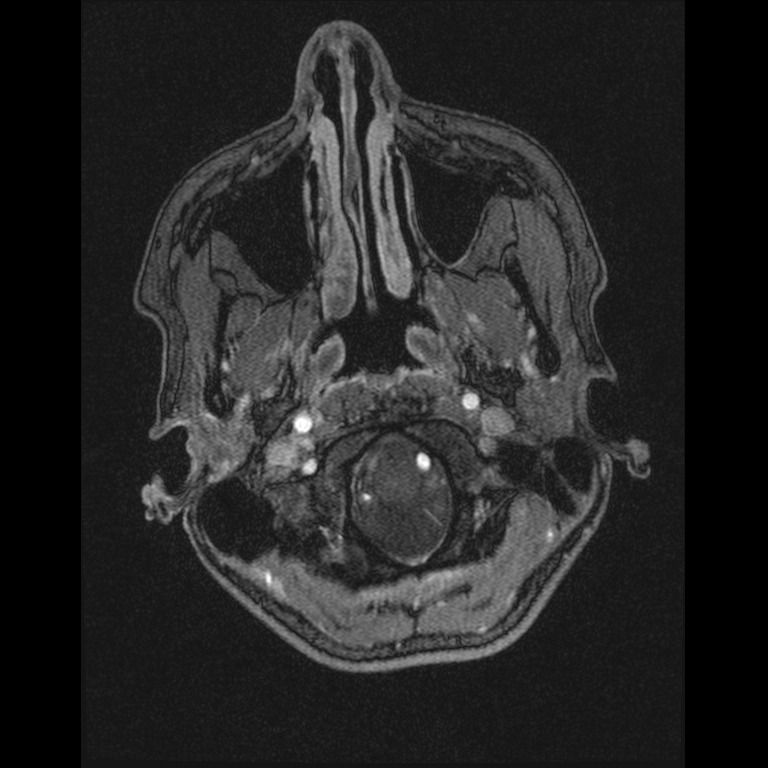 Cerebral venous thrombosis (Radiopaedia 45678-49854 Axial MRV 1).jpg