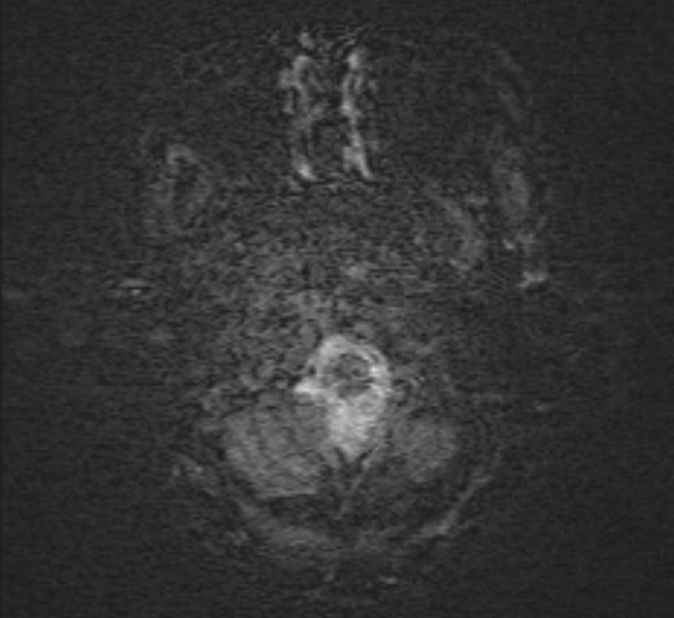 Cerebral venous thrombosis (Radiopaedia 71207-81504 Axial SWI 1).jpg