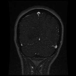 Cerebral venous thrombosis - ulcerative colitis (Radiopaedia 66049-75219 Coronal MRV 28).jpg