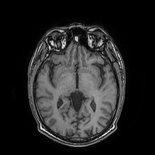 File:Cerebral venous thrombosis with secondary intracranial hypertension (Radiopaedia 89842-106957 Axial T1 90).jpg