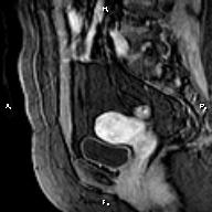 File:Cervical adenocarcinoma (Radiopaedia 65011-73985 E 11).jpg