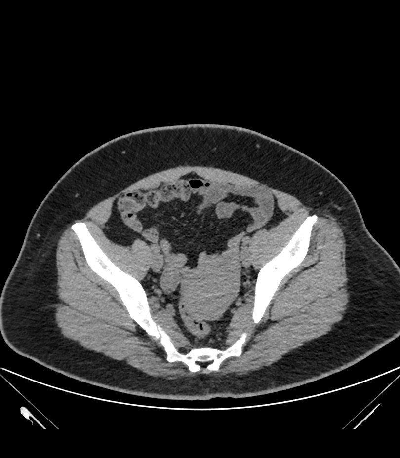 Cervical aortic arch with coarctation and aneurysms (Radiopaedia 44035-47552 Axial non-contrast 85).jpg