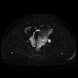 Cervical carcinoma (Radiopaedia 85405-101028 Axial DWI 53).jpg