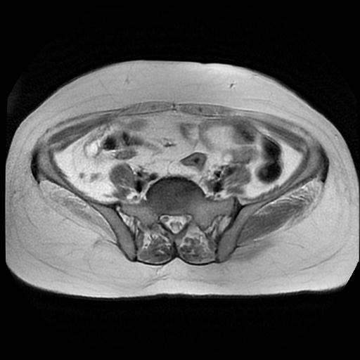 File:Cervical carcinoma (Radiopaedia 88010-104555 Axial T2 3).jpg