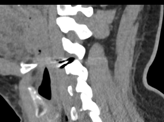 File:Cervical disc replacement (Radiopaedia 44025-47541 B 60).png