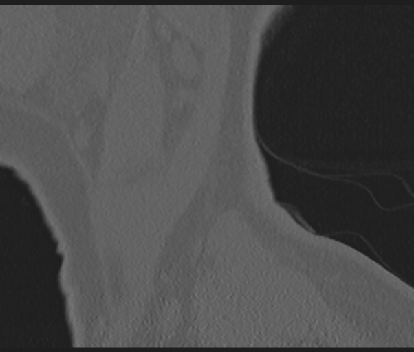 Cervical disc replacement (Radiopaedia 44025-47541 Sagittal bone window 82).png