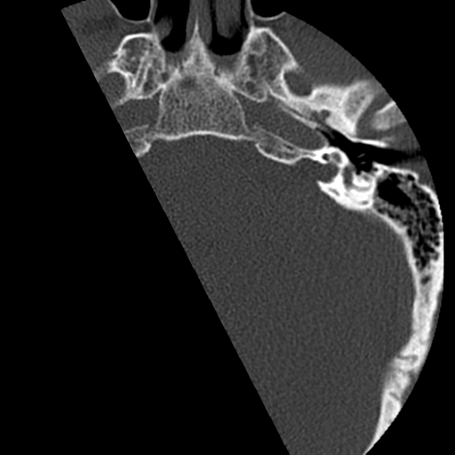 Cervical schwannoma (Radiopaedia 57979-64974 Axial bone window 2).png