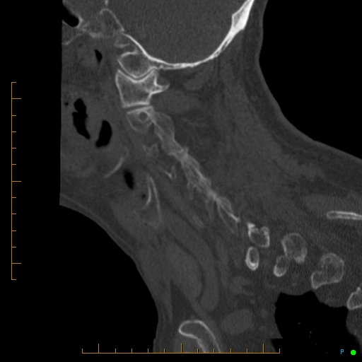 File:Cervical spine fracture - ankylosing spondylitis (Radiopaedia 76835-88706 Sagittal bone window 82).jpg