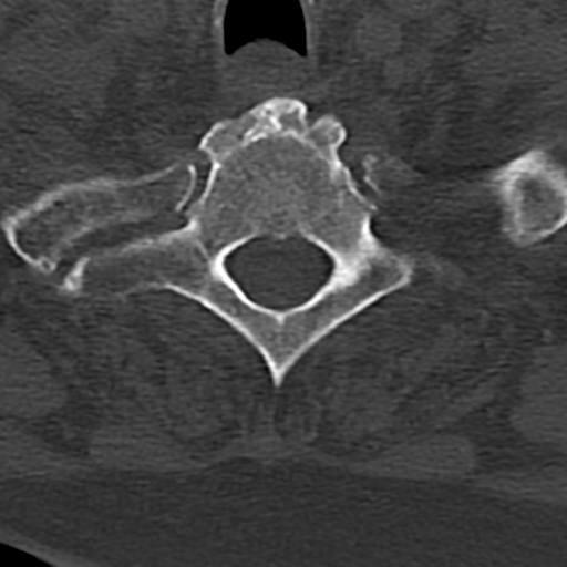 Cervical spine fracture - chalk stick (Radiopaedia 39116-41323 Axial bone window 82).png