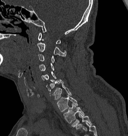 Cervical spine trauma with tear drop fracture and perched facet joint (Radiopaedia 53989-60127 Sagittal bone window 107).jpg