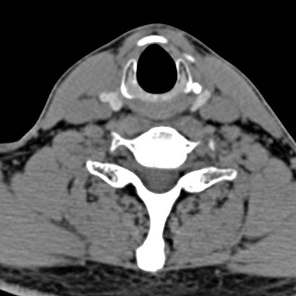 Cervical spondylodiscitis (Radiopaedia 28057-29489 Axial non-contrast 56).jpg