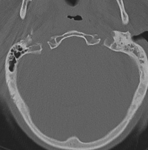 Cervical spondylolysis (Radiopaedia 49616-54811 Axial bone window 5).png