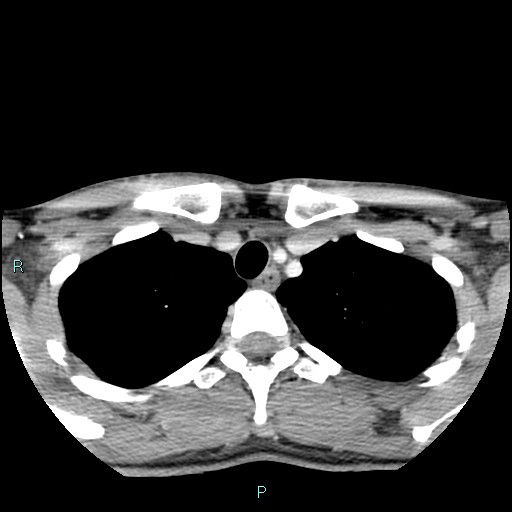 File:Cervical thymic cyst (Radiopaedia 88632-105335 C 19).jpg