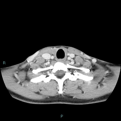 Cervical thymic cyst (Radiopaedia 88632-105335 C 38).jpg