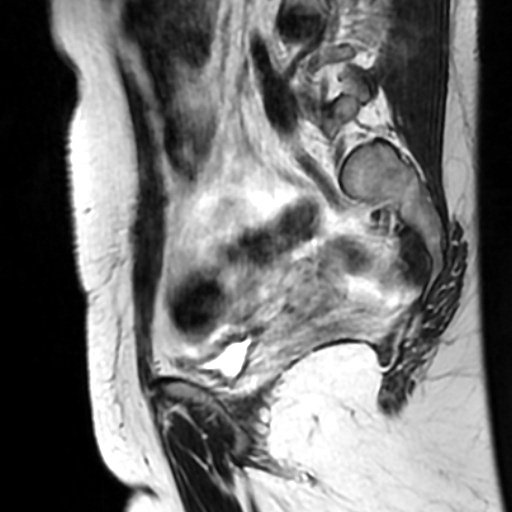 File:Cesarian section scar endometriosis (Radiopaedia 66520-75799 Sagittal T2 6).jpg