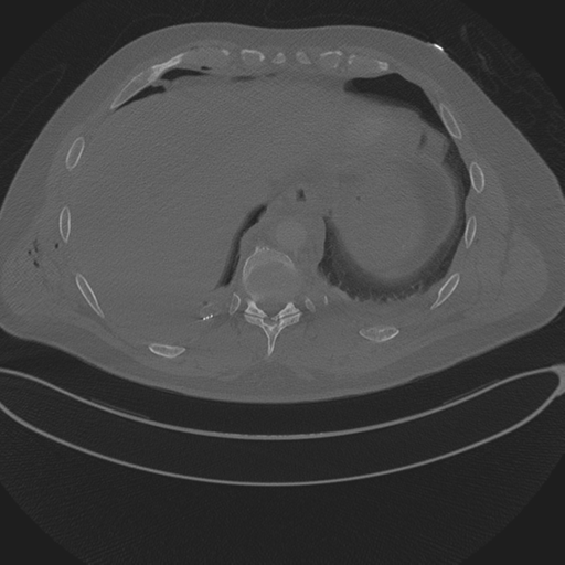Chest multitrauma - aortic injury (Radiopaedia 34708-36147 Axial bone window 244).png