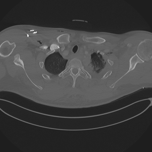 Chest multitrauma - aortic injury (Radiopaedia 34708-36147 Axial bone window 41).png