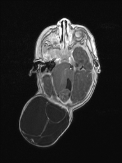 Chiari III malformation with occipital encephalocele (Radiopaedia 79446-92559 Axial T1 C+ mpr 38).jpg