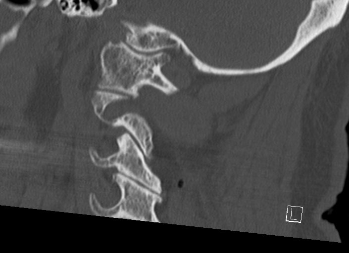 Chiari I malformation with a symptomatic syrinx of the posterolateral medulla oblongata (Radiopaedia 42573-45707 A 19).jpg