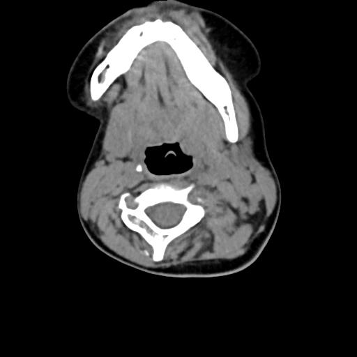 Chiari I with syrinx and skull base anomalies (Radiopaedia 89444-106412 Axial non-contrast 75).jpg