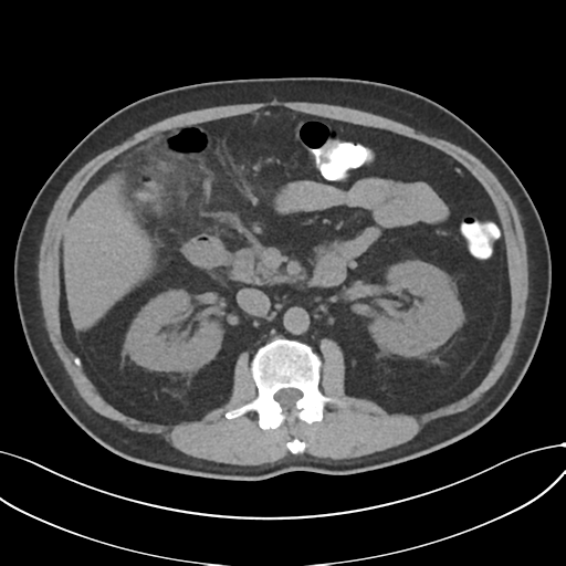 File:Cholecystitis with focal perforation and hepatic abscess (Radiopaedia 37189-38945 Axial non-contrast 34).png