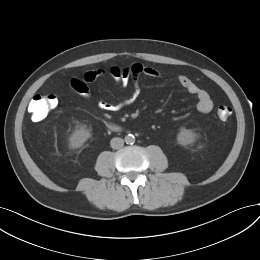 File:Cholecystitis with focal perforation and hepatic abscess (Radiopaedia 37189-38945 Axial non-contrast 46).png