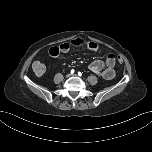 Cholecystoduodenal fistula due to calculous cholecystitis with gallstone migration (Radiopaedia 86875-103077 A 46).jpg