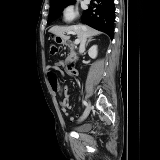 File:Choledocholiathiasis with normal caliber common bile duct (Radiopaedia 75368-86632 D 69).jpg