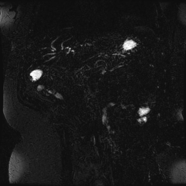 Choledocholithiasis on CT and MRI (Radiopaedia 24825-25088 Coronal T2 69).jpg