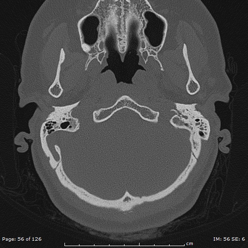 Cholesteatoma - external auditory canal (Radiopaedia 88452-105096 Axial bone window 19).jpg