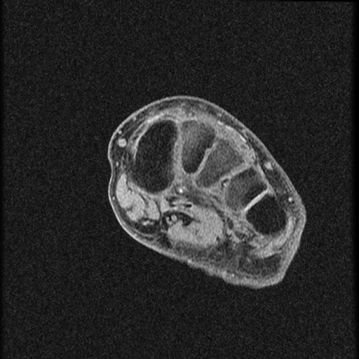 File:Chondroblastoma - midfoot (Radiopaedia 64831-73765 F 17).jpg