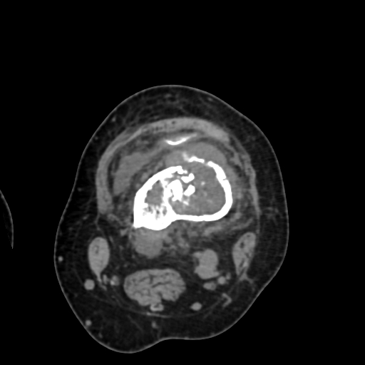 Chondrosarcoma - femur (Radiopaedia 64187-72954 Axial non-contrast 33).jpg