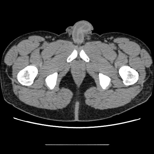 Chondrosarcoma of iliac wing (Radiopaedia 63861-72599 Axial non-contrast 123).jpg
