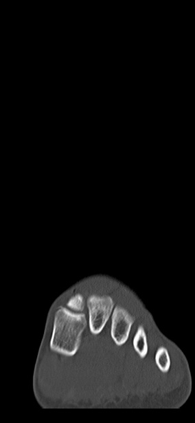 Chopart fracture (Radiopaedia 35347-36851 Coronal bone window 61).jpg