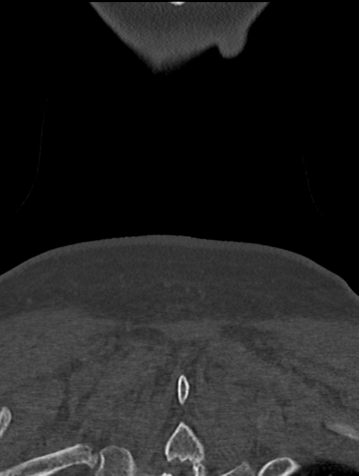 Chordoma (C4 vertebra) (Radiopaedia 47561-52188 Coronal bone window 68).png