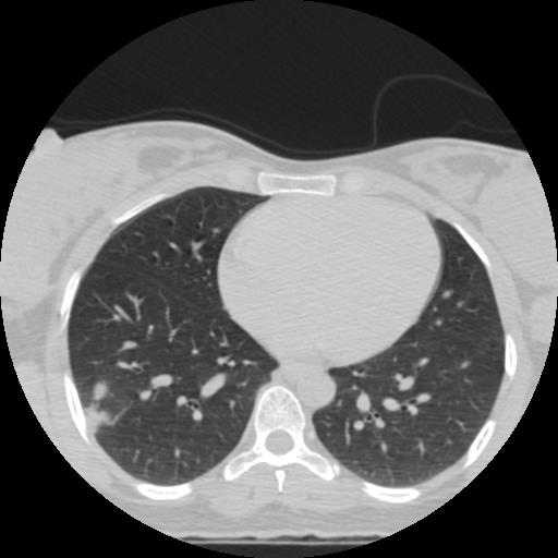 File:Choriocarcinoma of ovary with cerebral and pulmonary metastases (Radiopaedia 25983-26119 Axial lung window 3).jpg