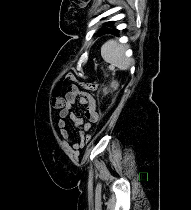 Chromophobe renal cell carcinoma (Radiopaedia 84239-99519 G 22).jpg