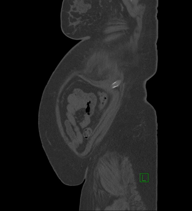 Chromophobe renal cell carcinoma (Radiopaedia 84239-99519 Sagittal bone window 7).jpg