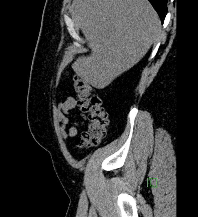 Chromophobe renal cell carcinoma (Radiopaedia 84286-99573 C 160).jpg