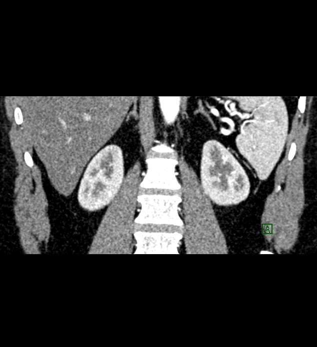 Chromophobe renal cell carcinoma (Radiopaedia 84286-99573 E 61).jpg