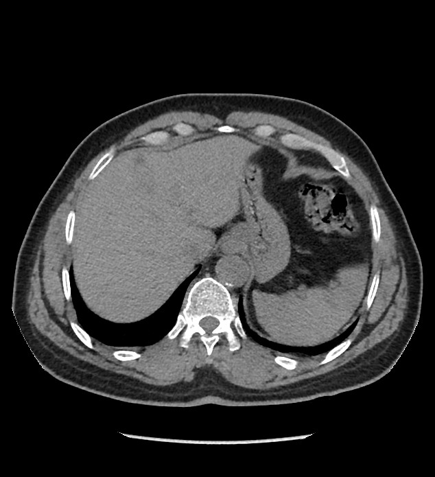 Chromophobe renal cell carcinoma (Radiopaedia 86879-103083 Axial non-contrast 5).jpg