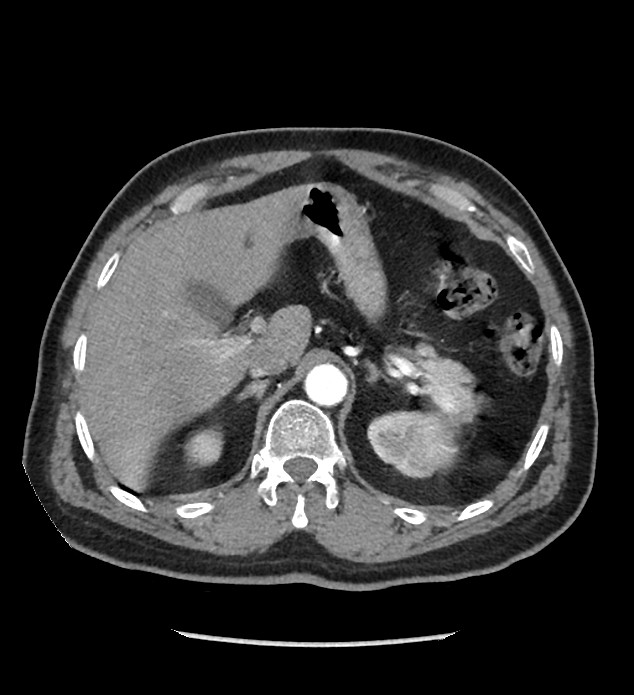 Chromophobe renal cell carcinoma (Radiopaedia 86879-103083 B 37).jpg