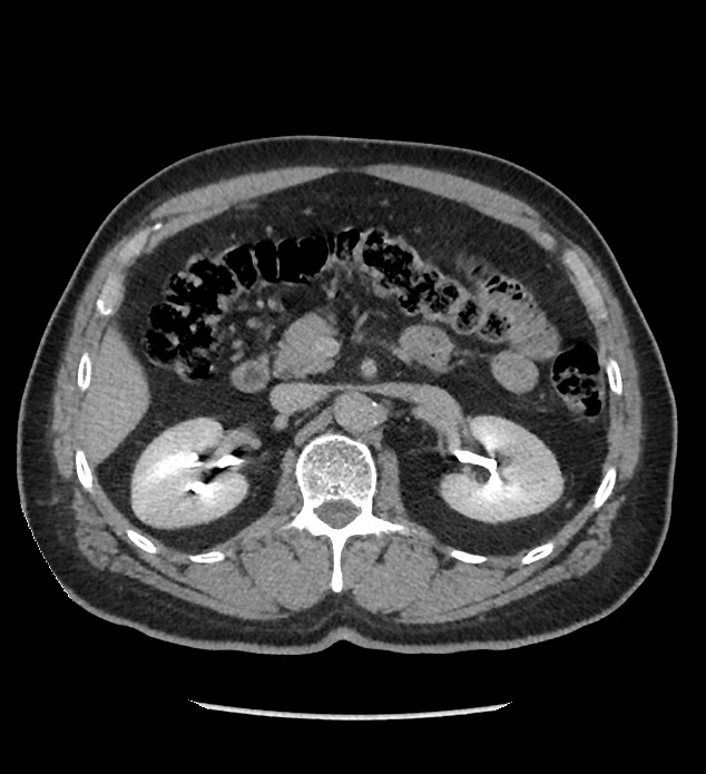 Chromophobe renal cell carcinoma (Radiopaedia 86879-103083 D 53).jpg