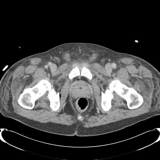 Chronic diverticulitis complicated by hepatic abscess and portal vein thrombosis (Radiopaedia 30301-30938 A 92).jpg