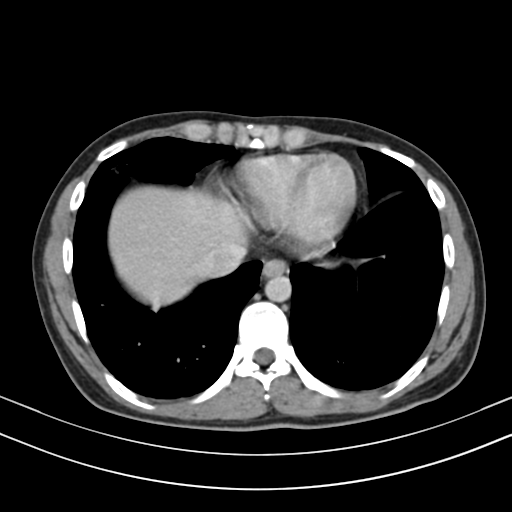 Chronic eosinophilic pneumonia (Radiopaedia 39331-41587 Axial C+ delayed 83).png
