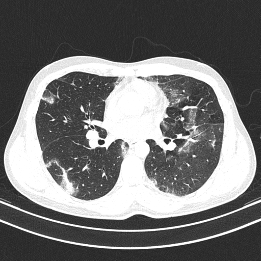 Chronic eosinophilic pneumonia (Radiopaedia 39331-41587 Axial lung window 27).png