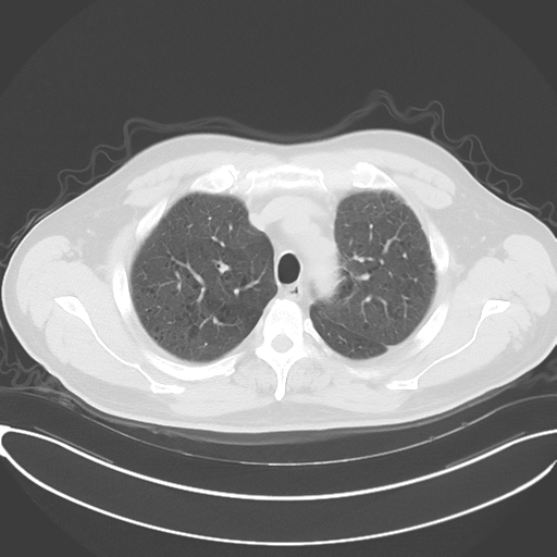 File:Chronic hypersensitivity pneumonitis (Radiopaedia 48107-52922 Axial lung window 18).png