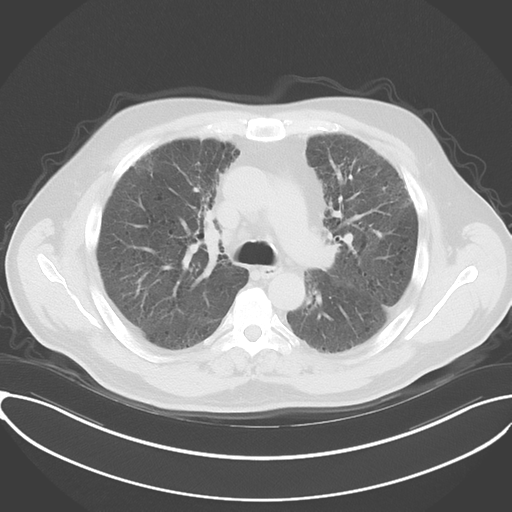 Chronic hypersensitivity pneumonitis (Radiopaedia 48107-52922 Axial lung window 26).png